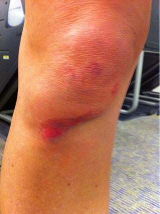 Illustration for article titled Erin Andrews Has Been Posting Pictures Of Various Bruises In Recent Days